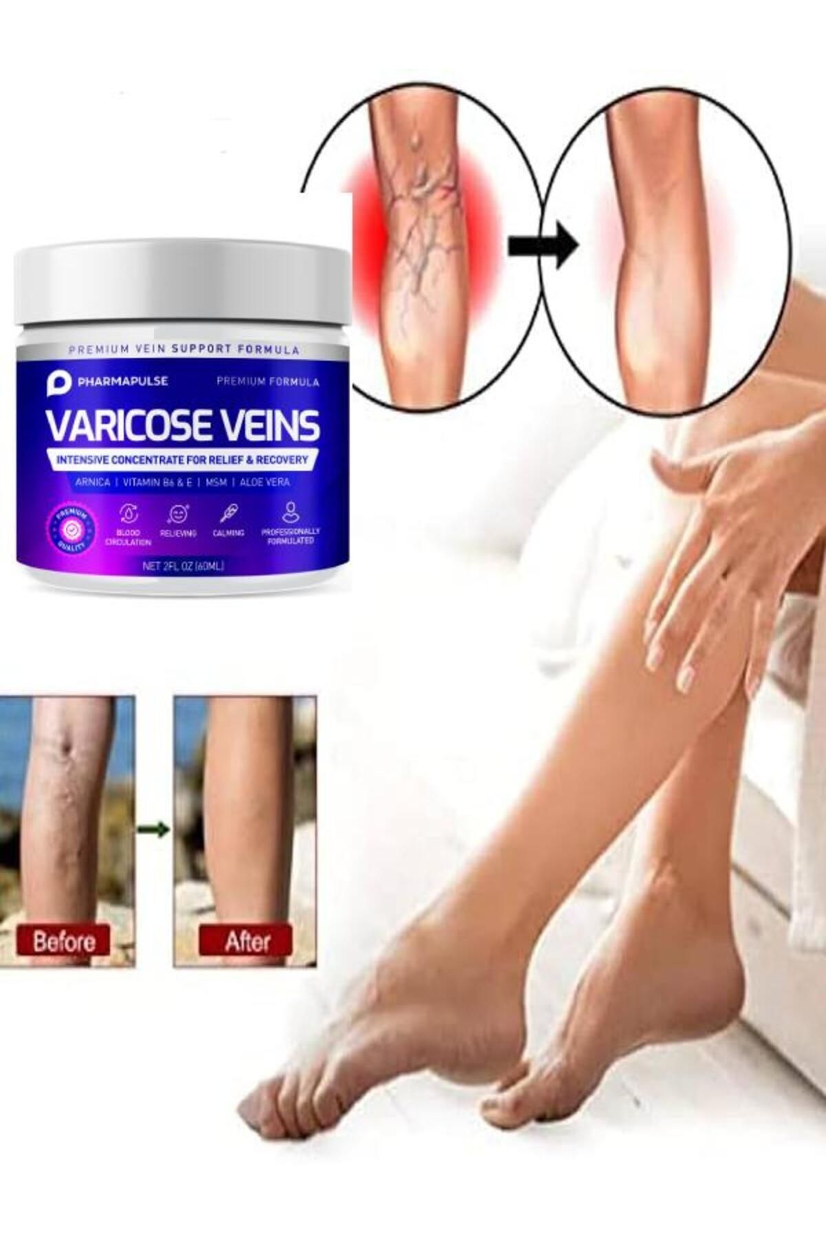 Alleben Maximum Strength Varicose Vein Var.is Bacak Bakım Masaj Kremi 100 ml
