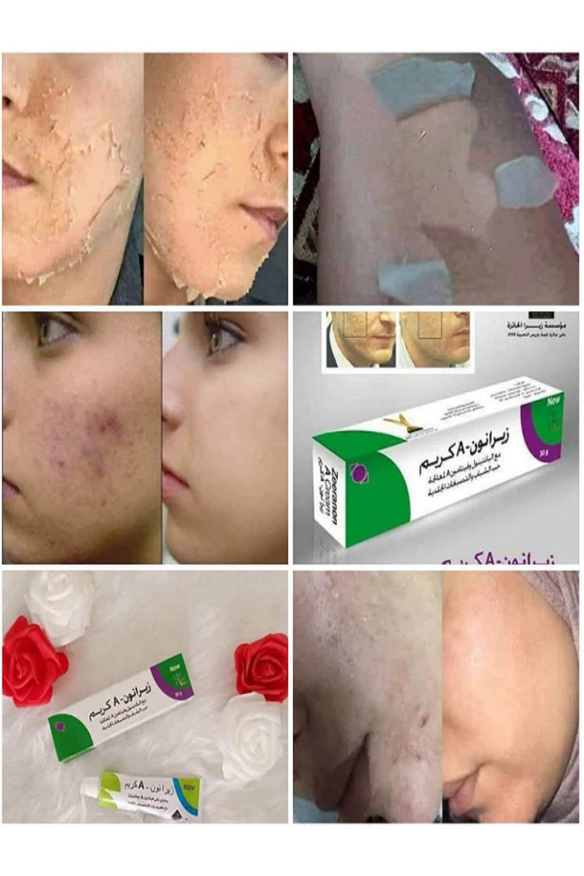 Zeeranon A Krem Melazma Kremi Çil Kremi Kremi Akne Ve Cilt Kusurları Onarıcı