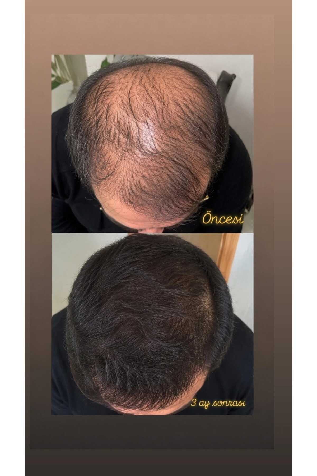 X-GrowthPecia Saç Çıkarıcı ve Gürleştirici Serum - 50 mL (PRP etkili büyüme faktörleri ve Mezoterapi etkili vitamin Komplexi.)